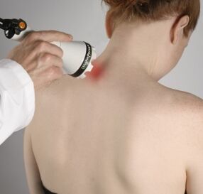Laserska terapija pomoći će ublažiti upalu i aktivirati regeneraciju tkiva u vratu