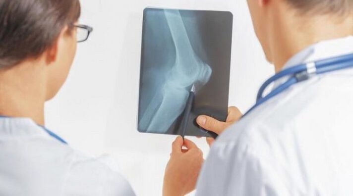 Nakon potrebne dijagnoze artroze zgloba koljena, liječnici propisuju složeni tretman