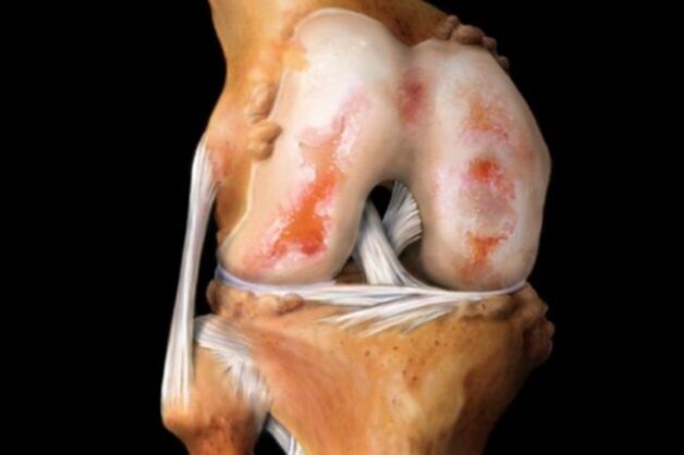 Uništavanje zgloba koljena zbog artroze - česta patologija mišićno-koštanog sustava