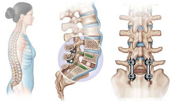 Fiksacija pomaknutih kralježaka implantatima u uznapredovalom stadiju osteohondroze