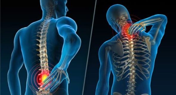 Znakovi koji ukazuju na razvoj osteohondroze - bol u vratu i donjem dijelu leđa