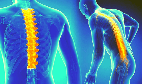 Osteohondroza kralježnice