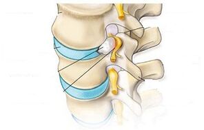Glavni simptomi cervikalne osteohondroze