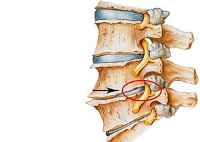 Uzroci cervikalne osteohondroze