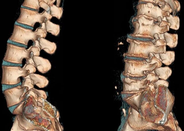 CT lumbalne kralježnice u normalnim uvjetima i s osteohondrozo