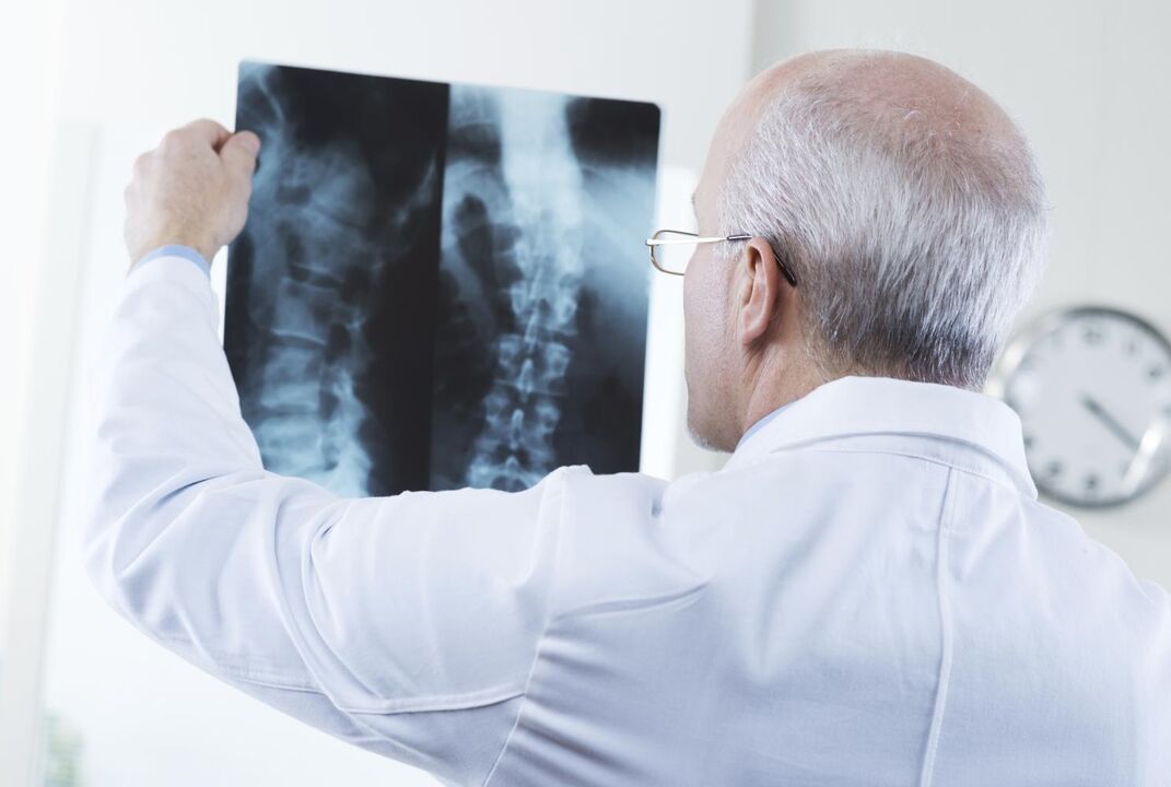 liječnik pregledava snimak vratne kralježnice s osteokondrozom