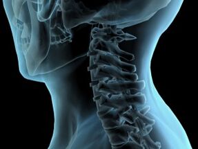 vratnih kralježaka s osteohondrozo