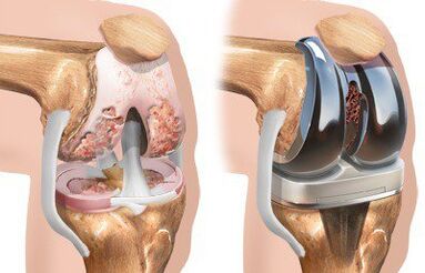 Endoprostetika zgloba koljena s gonartrozom