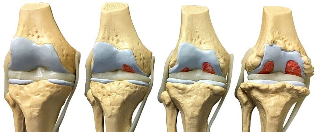 Stupnjevi artroze zgloba koljena